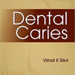 DENTAL CARIES By V.K. Sikri