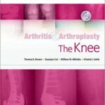Arthritis and Arthroplasty The Knee