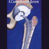Arthroplasty A Comprehensive Review