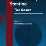 Carotid Artery Stenting The Basics