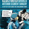 Illustrated Advanced Anterior Segment Surgery A Step-by Step Guide for Challenging Cases