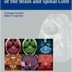 Cavernous Malformations of the Brain and Spinal Cord