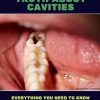 THE INCONVENIENT TRUTH ABOUT CAVITIES Everything You Need to Know About Cavities Between Your Teeth and a Tooth Decay
