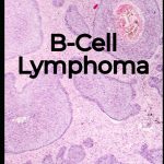 B Cell Lymphoma