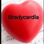 A Comprehensive Guide to Bradycardia Understanding Management and Future Horizons Medical care and health