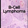 B Cell Lymphoma Medical care and health