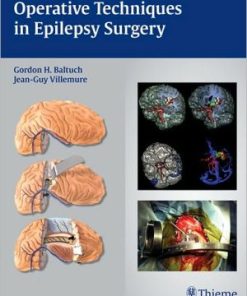 Operative Techniques in Epilepsy Surgery