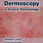Dermoscopy in General Dermatology