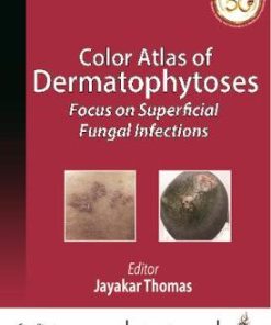 Color Atlas of Dermatophytoses Focus on Superficial Fungal Infections