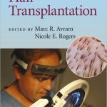 Hair Transplantation