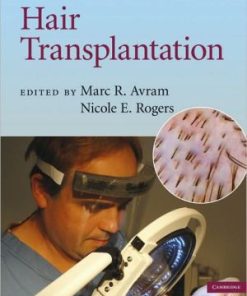 Hair Transplantation