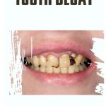 Tooth Decay Symptoms Causes Treatment and Prevention