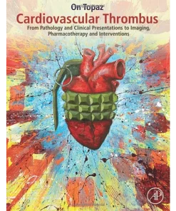 Cardiovascular Thrombus