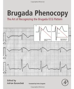 Brugada Phenocopy The Art of Recognizing the Brugada ECG Pattern