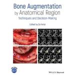 Bone Augmentation by Anatomical Region