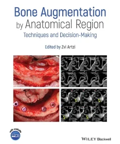 Bone Augmentation by Anatomical Region