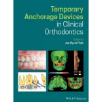 Wiley-Blackwell Temporary Anchorage Devices in Clinical Orthodontics