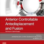 Anterior Controllable Antedisplacement and Fusion
