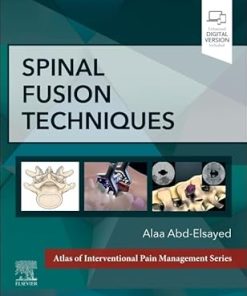 Spinal Fusion Techniques