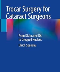 Trocar Surgery for Cataract Surgeons
