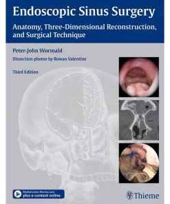 Endoscopic Sinus Surgery