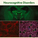 HIV-Associated Neurocognitive Disorders