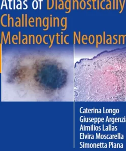 Atlas of Diagnostically Challenging Melanocytic Neoplasms
