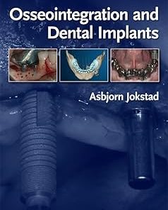 Osseointegration and Dental Implants