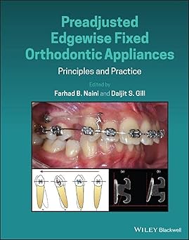 Preadjusted Edgewise Fixed Orthodontic Appliances